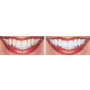 Tooth Whitening